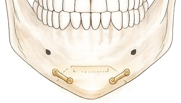 オトガイ形成術（顎先の骨切り・固定）のイメージ図