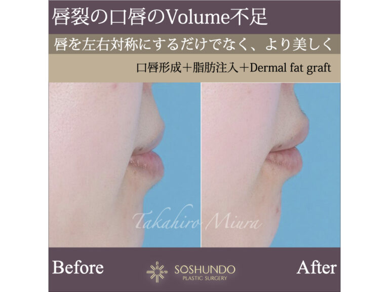 唇裂の唇のボリューム感をよりよく見せるために。