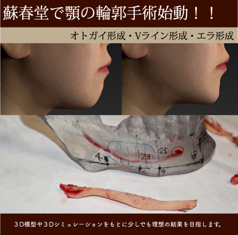 輪郭形成（オトガイ・Vライン・エラ）を開始しました｜顎の骨切りによるフェイスライン形成